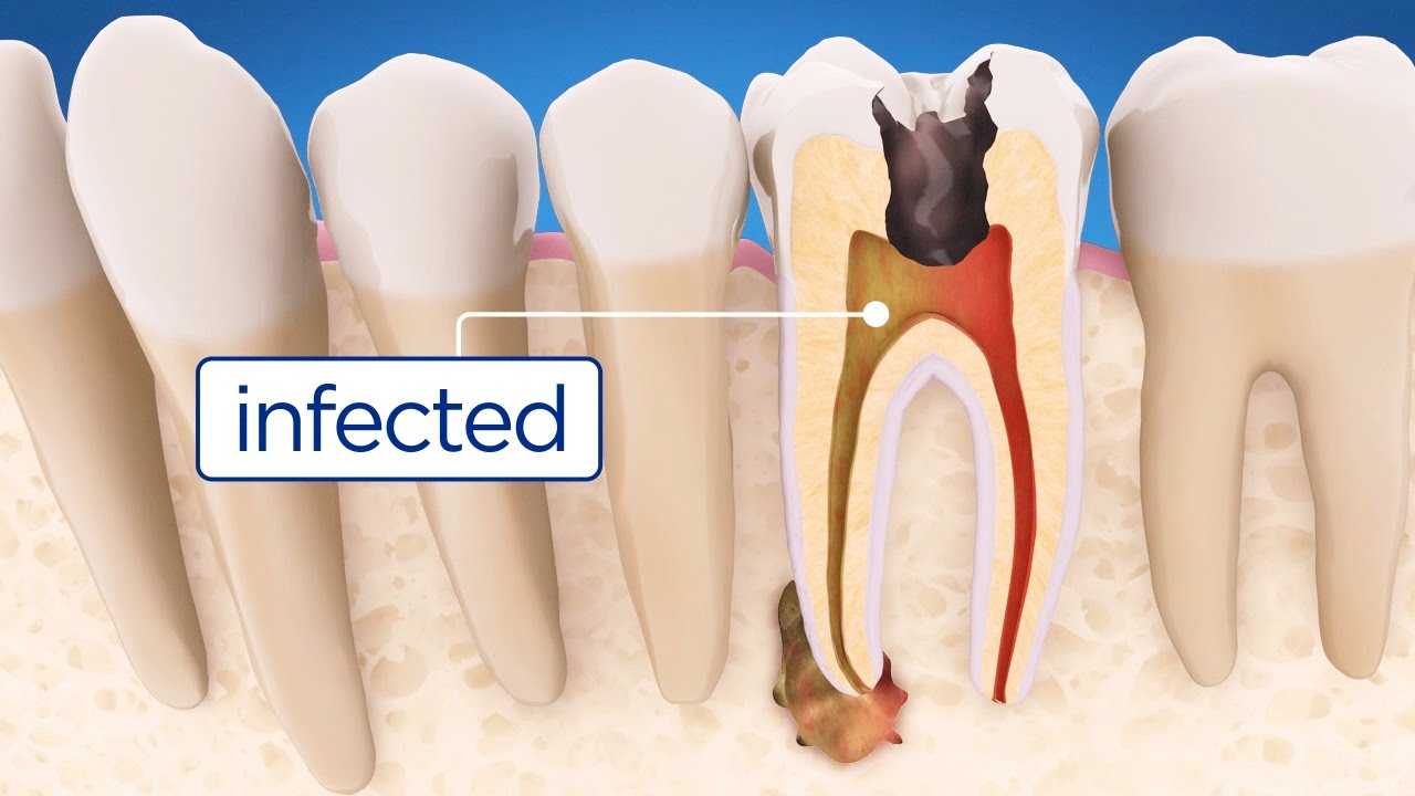 Root-canal-treatment