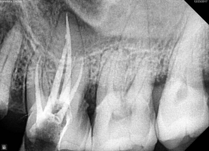 Root-canal-Therapy