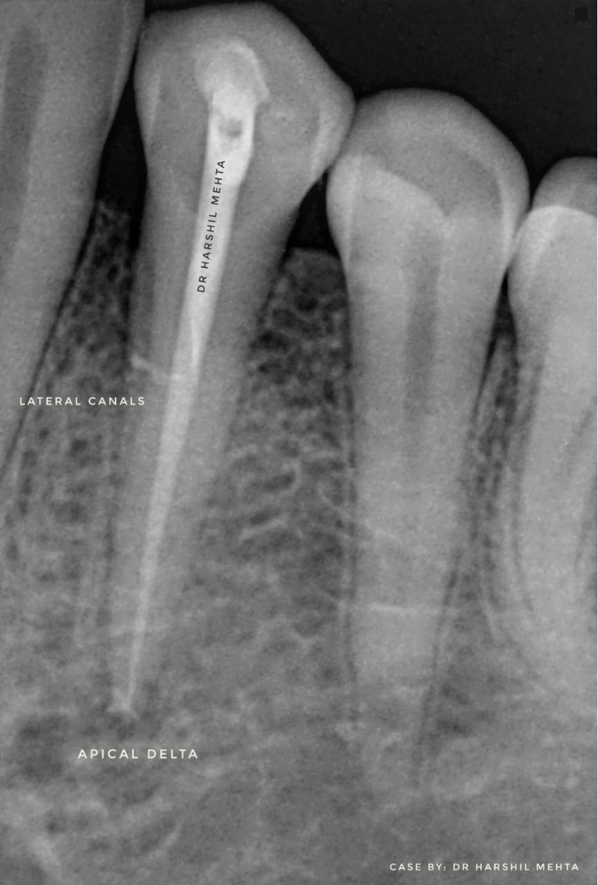 Multiple-Visit-Root-Canal-Therapy